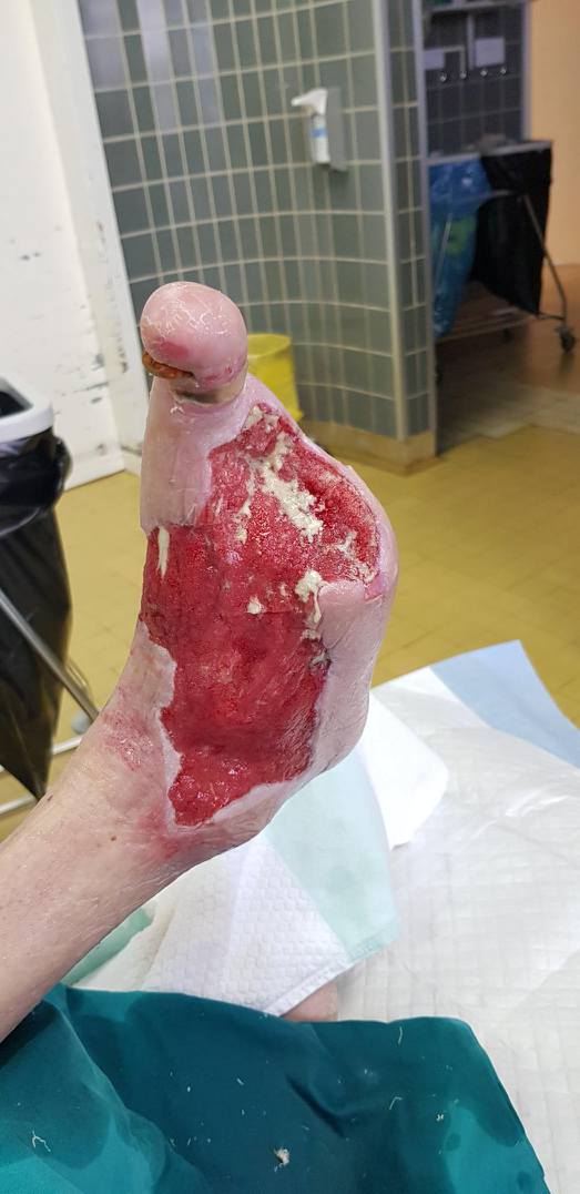 Rana na stopalu se celi s svežimi granulacijami, kar je dobro za bolnika